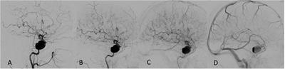 Critical Angiographic and Sonographic Analysis of Intra Aneurysmal and Downstream Hemodynamic Changes After Flow Diversion